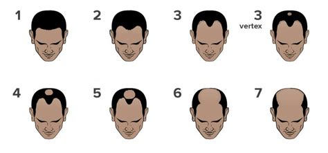 Understanding Hair Loss with Norwood Scale