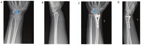 Successful Surgical Treatment Of A Type Iii Fracture A Download