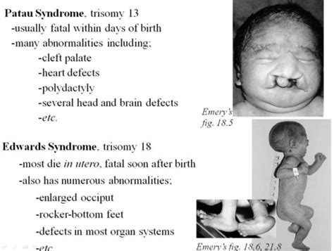 Patau Syndrome Symptoms Pictures