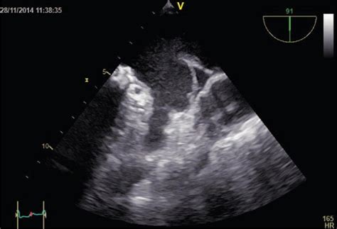 Transesophageal Echocardiogram Showing Severe Left Atrial Spontaneous Download Scientific