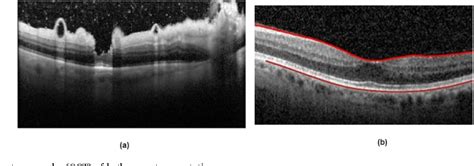 Metastatic Squamous Cell Carcinoma Masquerading As Acute Retinal Necrosis Semantic Scholar