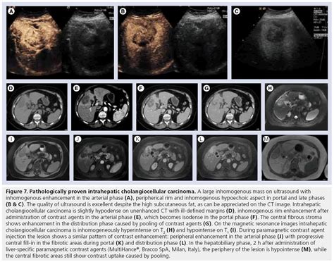 Optimal Imaging Of Focal Liver Lesions