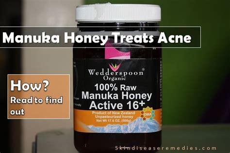 Manuka Honey for Acne and Acne Scars