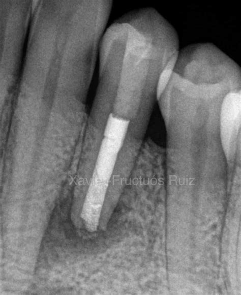 Mta Apexification Procedure Of An Immature Mandibular Premolar With A