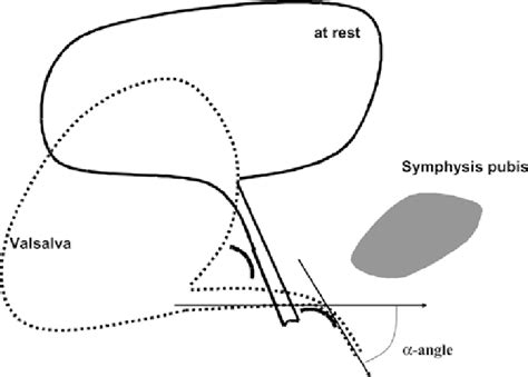 Schematic Illustration Of How Tension Free Vaginal Tape Corrects Stress Download Scientific