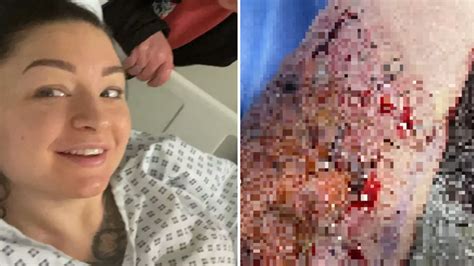 Woman Left In A Wheelchair For Weeks As She Suffered Third Degree Burns