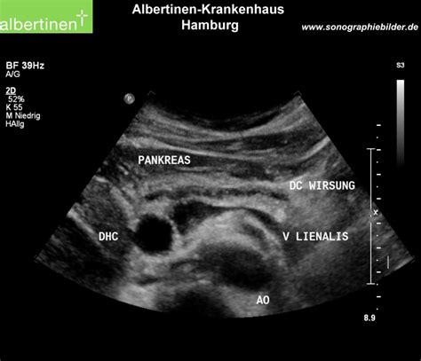 Chronic Pancreatitis DocCheck