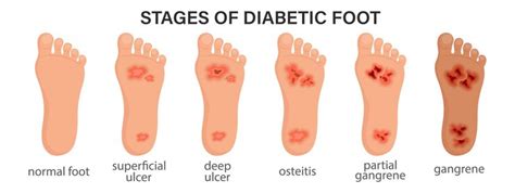 stages  diabetic foot syndrome deep ulcer open wound   foot