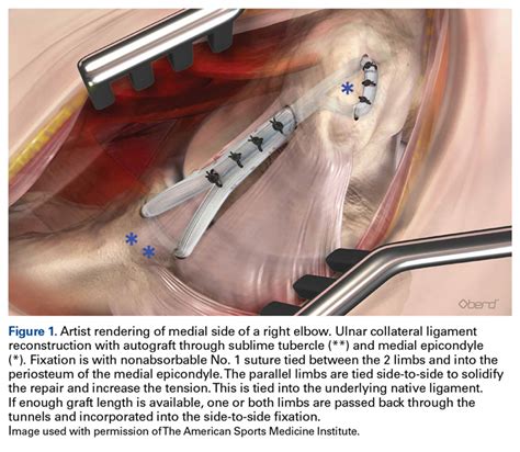 Ulnar Collateral Ligament Reconstruction Current Philosophy In 2016 Mdedge Surgery