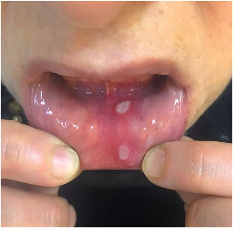 The skin in Behçet s disease Mucocutaneous findings and differential