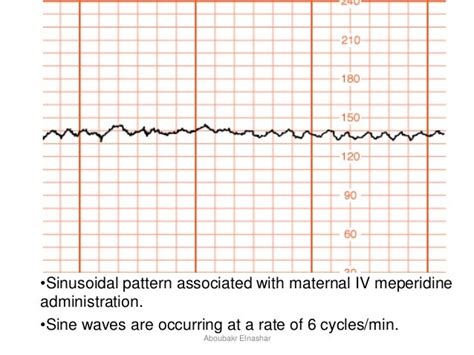 Ctg Patterns