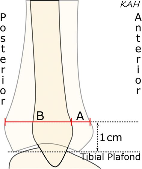 The Anterior Tibiofibular Ratio Seen On Lateral Ankle Radiographs As Download Scientific