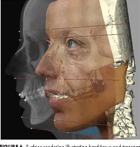 Figure From Three Dimensional Treatment Planning Of Orthognathic