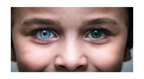 All You Need to Know About Heterochromia | OBN