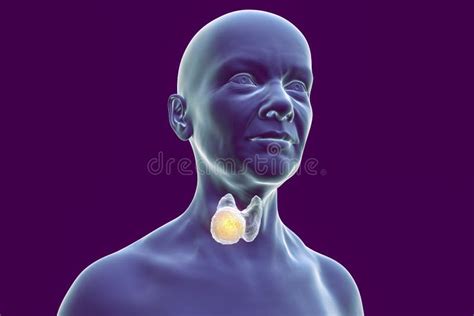 Thyroid Cancer In Women Illustration Showing Tumor Inside Thyroid