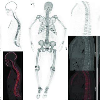 F Naf Pet Ct Increase Bone Metabolism Increase Bone Turnover A