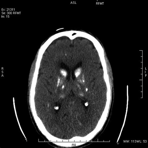 Basal ganglia calcification | BMJ Case Reports