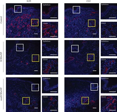 Expression Of Slpi And Clu At The Protein Level In Nasal Tissues Of