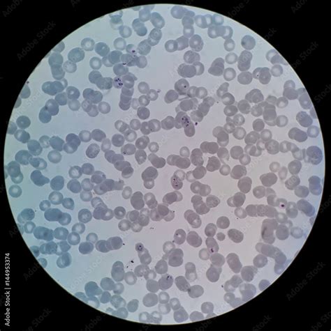 Plasmodium Falciparum Under Microscope