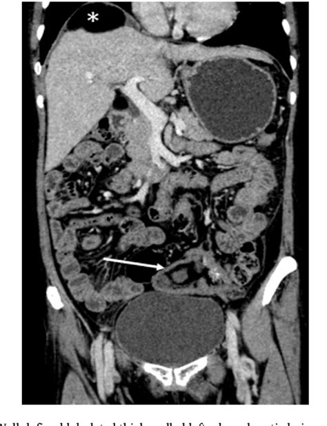 Ruptured Dermoid Cyst Of Ovary Developing Into Chronic Peritonitis A