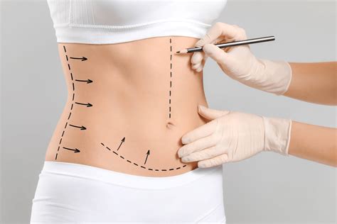 Todo Sobre La Abdominoplastia Cl Nica Est Tica Cemeq