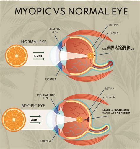 Myopia Control | Fort Myers Eye Associates