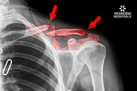 Broken Collarbone: Symptoms and Complications