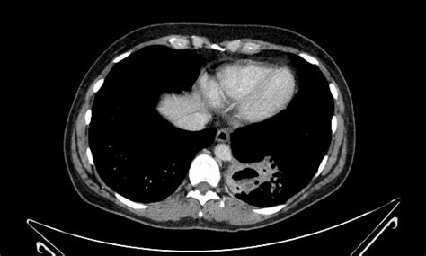 Pulmonary Sequestration Image Radiopaedia Org