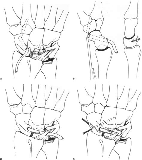 Three Ligament Tenodesis For The Treatment Of Scapholunate Dissociation