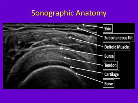 How To Give Shoulder Joint Injection Using Medical Ultrasound