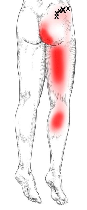 Gluteus Medius Trigger Points