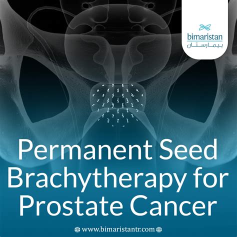 permanent seed brachytherapy  prostate cancer bimaristan