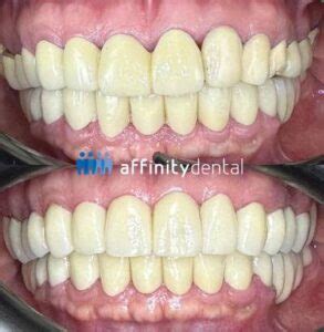 Pfm Vs Zirconia Crowns And Bridges Affinity Dental Clinics