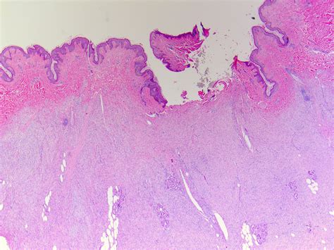 Dermatofibrosarcoma Pathology Outlines