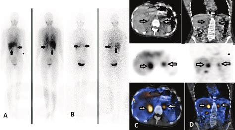 Iodine Metaiyodobenzilguanidin Scintigraphy Findings Of Case