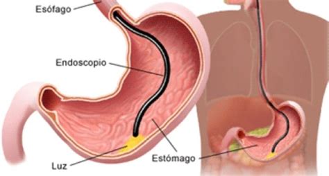 Esfínter Esofágico O Enfermedad De Reflujo Gastroesofágico Erge