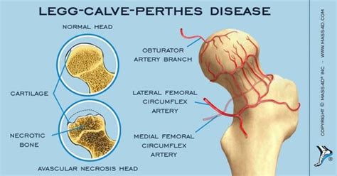 Differential Diagnosis Of Hip Pain Flashcards Quizlet