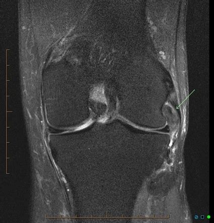 Popliteus Tenosynovitis