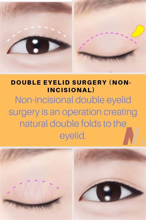 Non Incisional Double Eyelid Surgery