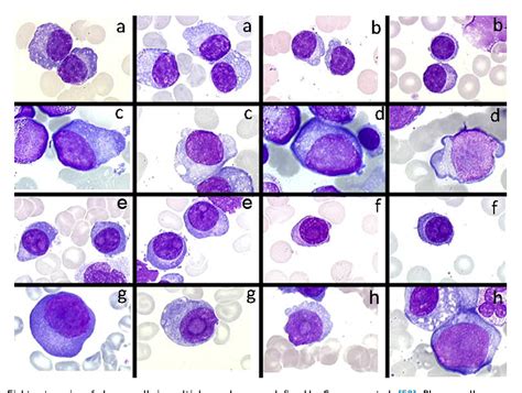 Figure From Plasma Cell Morphology In Multiple Myeloma And Related