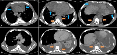 Mysterious Overnight Disappearance Of Mediastinal Mass Bmj Case Reports