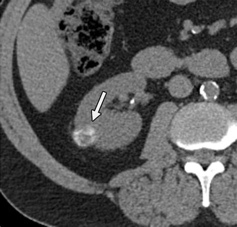 Diagnostic Approach To Benign And Malignant Calcifications In The Abdomen And Pelvis Radiographics