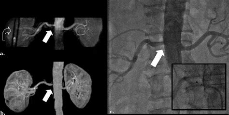 Renal Sympathetic Denervation Potential Role Of Noncontrast Magnetic Resonance Angiography