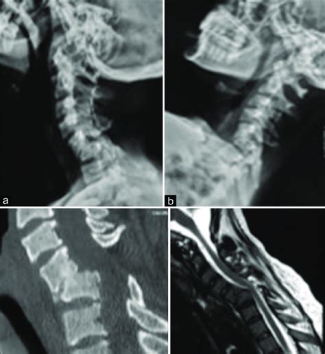 A Lateral X Ray Showing Dislocation Of At C5 C6 B Lateral X Ray In Download Scientific