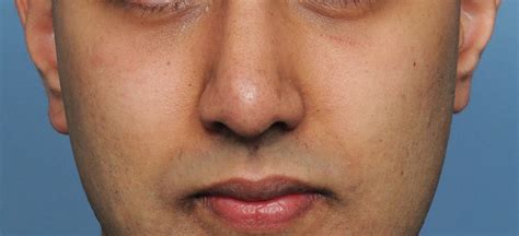 Plastic Surgery Case Study Achieving A Non Osteotomy Midface