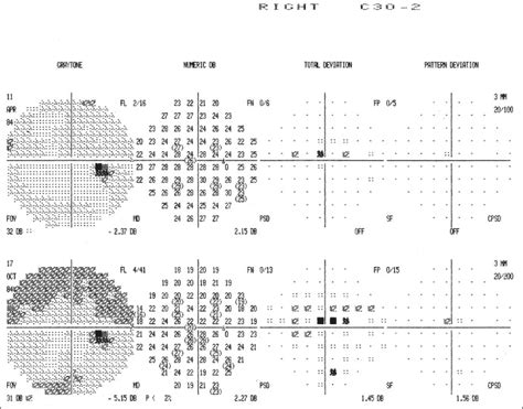 Techniques and variables in visual field testing | Ento Key