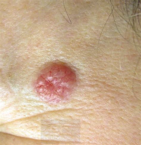 Skin Cancer And Precancerous Skin Lesions What You Need To Know Skin