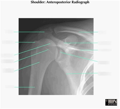 Shoulder Anteroposterior Radiograph Diagram Quizlet