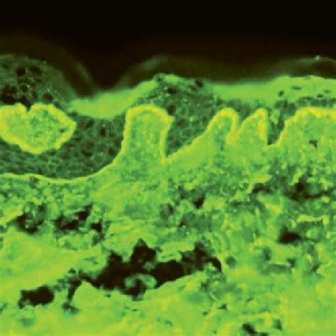 Bullous Pemphigoid Hande Stained Section At 10× Showing A Subepidermal Download Scientific