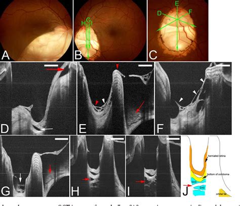 Figure From Evaluation Of Congenital Optic Disc Pits And Optic Disc